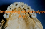 мплантация зубов фиксация с помощью усиленной армированной конструкции